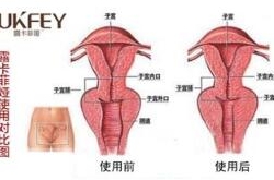 自然缩阴最快的方法